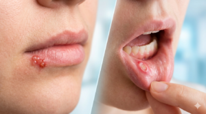 Cold Sore vs Canker Sore