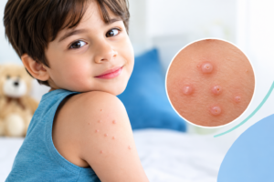 Molluscum Contagiosum in Children