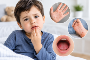 Hand Foot and Mouth Disease